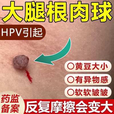 大腿根部皮赘小肉粒球皮肤纤维瘤