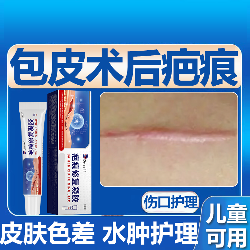 包皮手术后疤痕增生凸起去除水肿修色差色素沉淀护理祛疤膏复wg