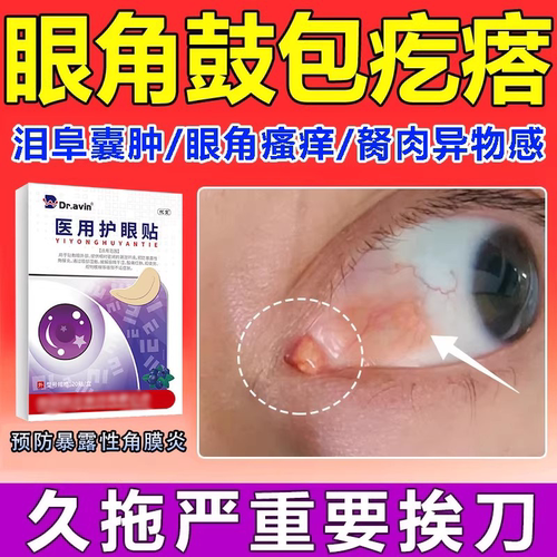 眼角泪阜囊肿胬肉疙瘩瘙痒异物感