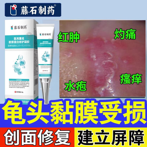 男性龟头黏膜修复龟头炎红斑破损起水泡红肿瘙痒专用真菌感染xj