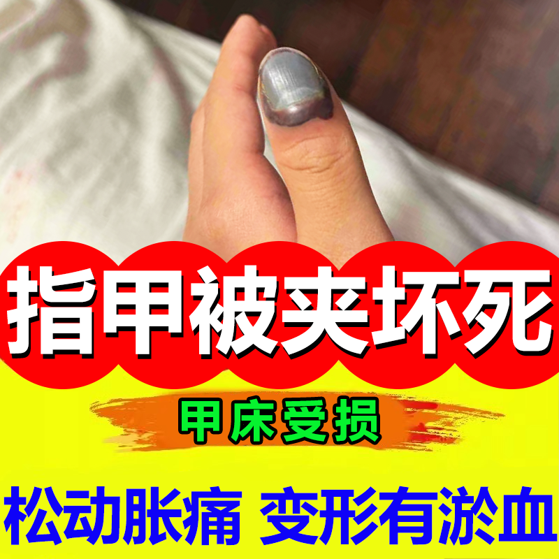 手指甲被夹伤淤血坏死重组生长液