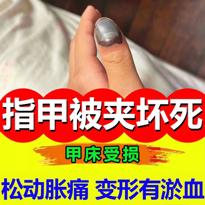 手指甲被夹伤淤血坏死重组生长液