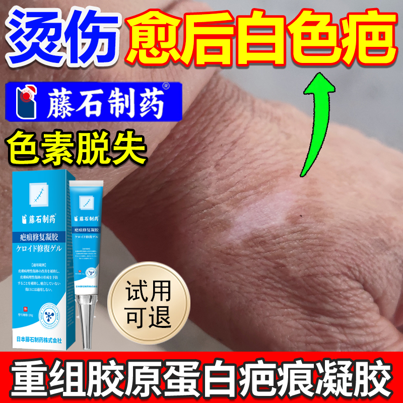 【药监局备案】烫伤愈后白色疤痕