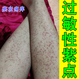 紫点四肢皮下出血瘀斑过敏色素性紫点血斑血点红点老人儿童专用膏