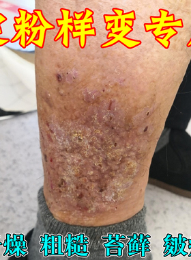 皮肤淀粉样变专用皮肤粗糙颗粒顽固黑色素沉淀真菌感染小腿痒苔变