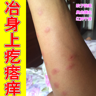 冶身上疙瘩痒荨麻毒虫蚊虫叮咬疥螨疥虫咬皮肤红肿长痘痘专用修复