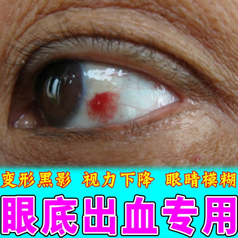 眼底出血眼睛发炎过敏性眼角越揉越痒红血丝视线模糊飞蚊症眼药水