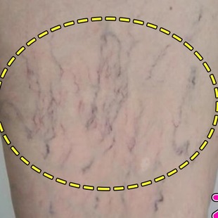 腿上有红血丝冷敷凝胶去除女性腿部毛细血管扩张修复软膏