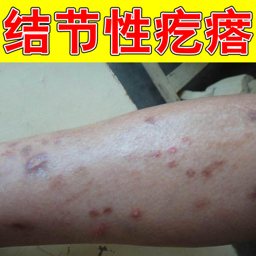 结节性疙瘩凸起硬疙瘩粗糙掉屑红肿老年人晚上睡不着皮肤痒长红斑