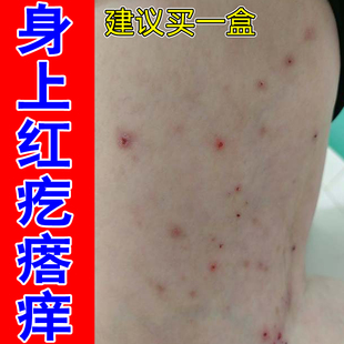 身上红疙瘩痒全身皮肤痒起小红点小腿上硬疙瘩后背痘痘专用修复药