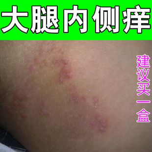 下巴长闭口红肿痘痘小颗粒小疙瘩痘印冒白尖出油多生理期专用