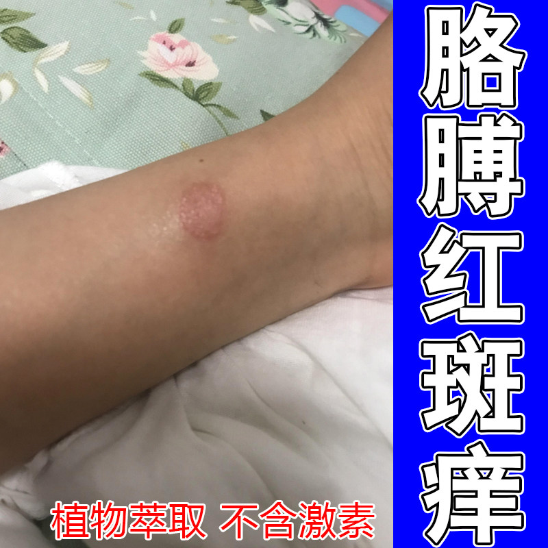 身上圆形斑块干屑刺痒脱皮粗糙泛护手霜