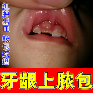 牙龈长脓包牙根尖上鼓包肿痛智齿发炎上火儿童出血干燥专用修复药