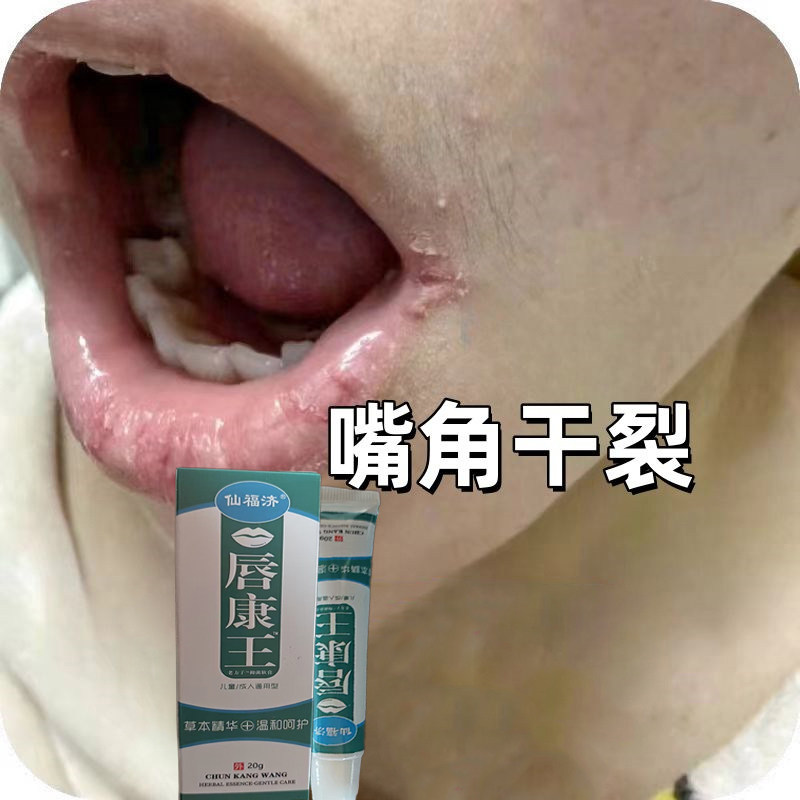 嘴角水疱口唇药儿童成人专用软膏嘴巴上火起泡烂红肿修复羊胡子疮