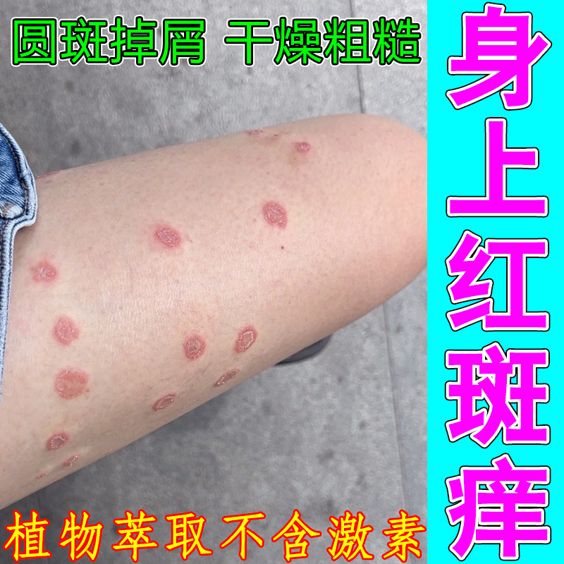 身上红斑痒皮肤干燥粗糙过敏干痒冶猫咪传染掉屑起皮鳞屑