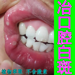 口腔白色念珠口腔菌唇舌黏膜白斑烂烧灼感口干扁平溃烂草本喷剂