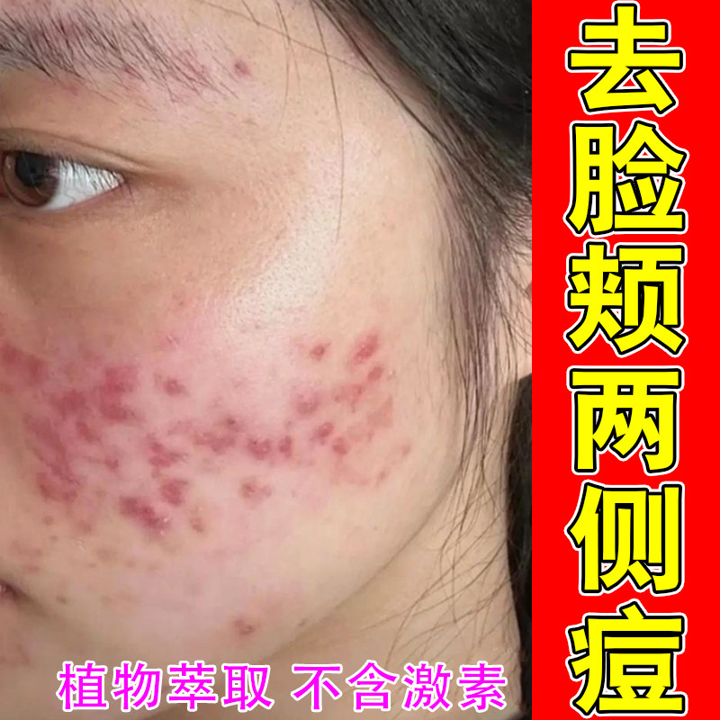 去脸颊两侧痘皮肤红肿过敏干燥起疙瘩脓包起皮掉屑闭口粉刺脓包痘