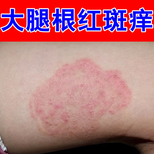 大腿根红斑痒红肿疙瘩腿两侧脱皮掉屑长痘男人下面痒潮湿感染修护