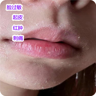 起皮脸上皮脸干干皮脱皮干痒秋冬季脸部掉皮发痒皮肤粗糙起干皮