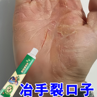 手指头裂口子干裂修复护手霜开裂脱皮裂开手足开口手脚冬季裂膏