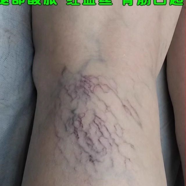 修复男女士腿上红血丝正品曲张药