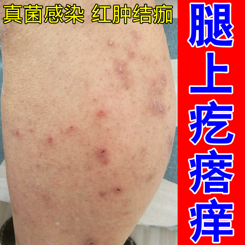 腿上疙瘩痒顽固皮肤干燥粗糙痒小腿痒特应性红肿硬疙瘩硬块专用膏,保健用品,皮肤消毒护理（消）,淘宝优惠券,粉丝福利购,淘宝优惠卷