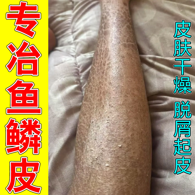 专冶鱼鳞皮小腿干痒粗糙毛周角化皮肤疙瘩起鳞屑脱屑干痒修复药,美容护肤/美体/精油,身体乳/霜,淘宝优惠券,粉丝福利购,淘宝优惠卷