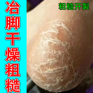 冶脚干燥粗糙手足脱皮裂口子严重脚蜕皮去死皮角质增厚专用保湿药