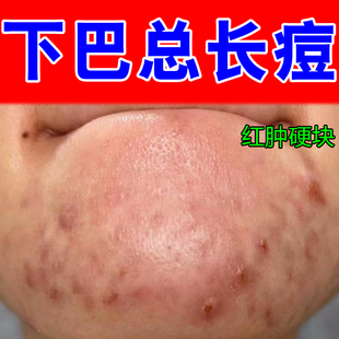 闭口粉刺的克星去痘痘脸上硬块脓包红肿坐疮淋巴痘腮边痘专用修复