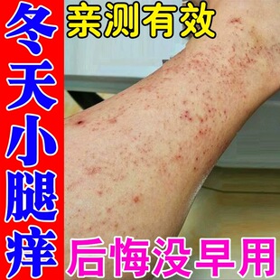 腿痒小腿皮肤痒腿上干燥起皮膏冬天腿部发痒长小红点疙瘩过敏专用
