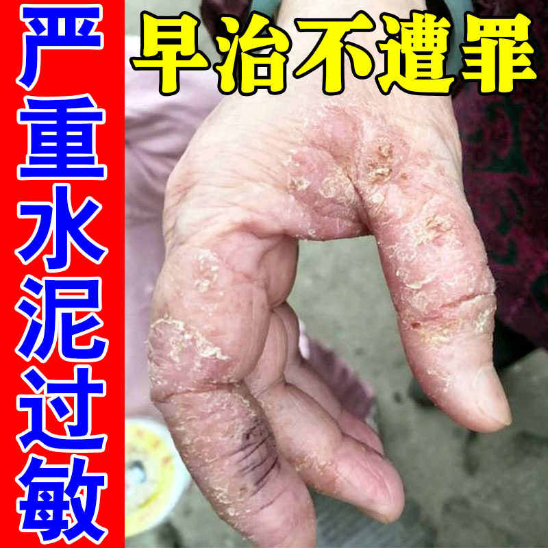 冶手上水泥过敏建筑专用手痒起小水泡皮肤干痒红肿干裂脱皮乳膏