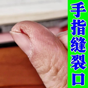 手指甲缝裂口子干裂修复霜秋冬天手指头粗糙开裂脱皮疼痛防皲裂膏
