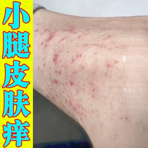 治腿痒的药秋冬天小腿皮肤痒腿上长红点疙瘩干燥起皮过敏发痒乳膏