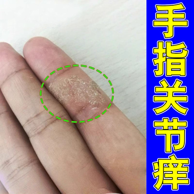 手指关节痒皮肤干燥粗糙感染草本修护软膏手指长硬皮发痒严重