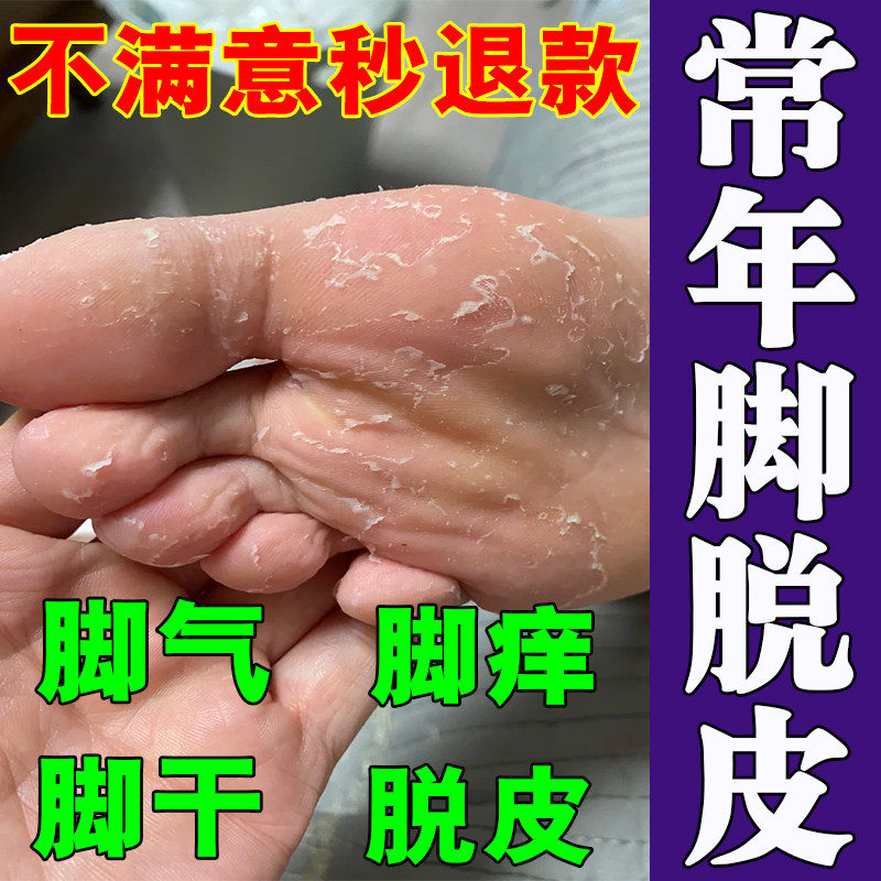 脚气止痒脱皮脚痒水泡脱皮烂脚丫去痒臭脚脱皮用什么药脚脱皮发痒