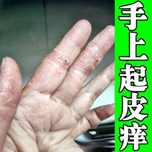 手痒膏脱皮干裂真菌感染起皮手上小水泡干燥开裂脱皮外用修复乳膏