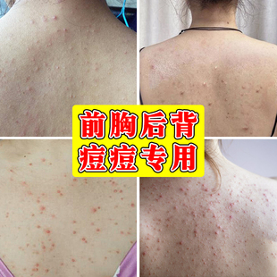 前胸后背祛痘背上长痘痘后背毛囊焱炎除去螨虫痘印神器外用修复膏