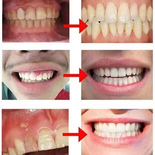 极速牙龈脓c//包牙龈囊//肿长肉球流脓发//炎牙周//炎肿胀痛喷剂