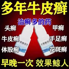 牛皮癣药水银屑病外用皮肤瘙痒起皮体股癣手足癣去癣克霉唑溶液