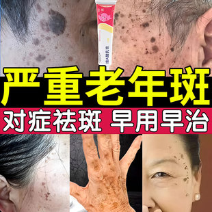 维a酸乳膏去老年斑医用去斑专用药膏非强力去除老年斑黄褐斑雀斑
