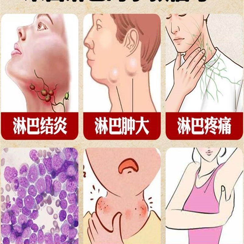 新品【200%管用】淋巴结消散结膏脖子肿专科用疏通W神器副乳去消