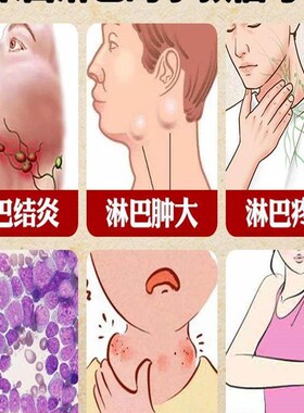 新品【200%管用】淋巴结消散结膏脖子肿专科用疏通W神器副乳去消