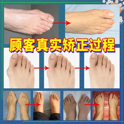 极速【早用早g直】拇指外翻矫正贴膏治大脚骨疼痛变形脚趾重叠专