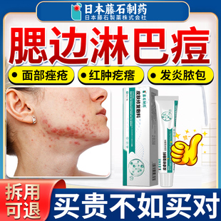 淋巴痘腮边痘专用下巴脸颊两边长痘引起痤疮结节硬块痘药房同售JV