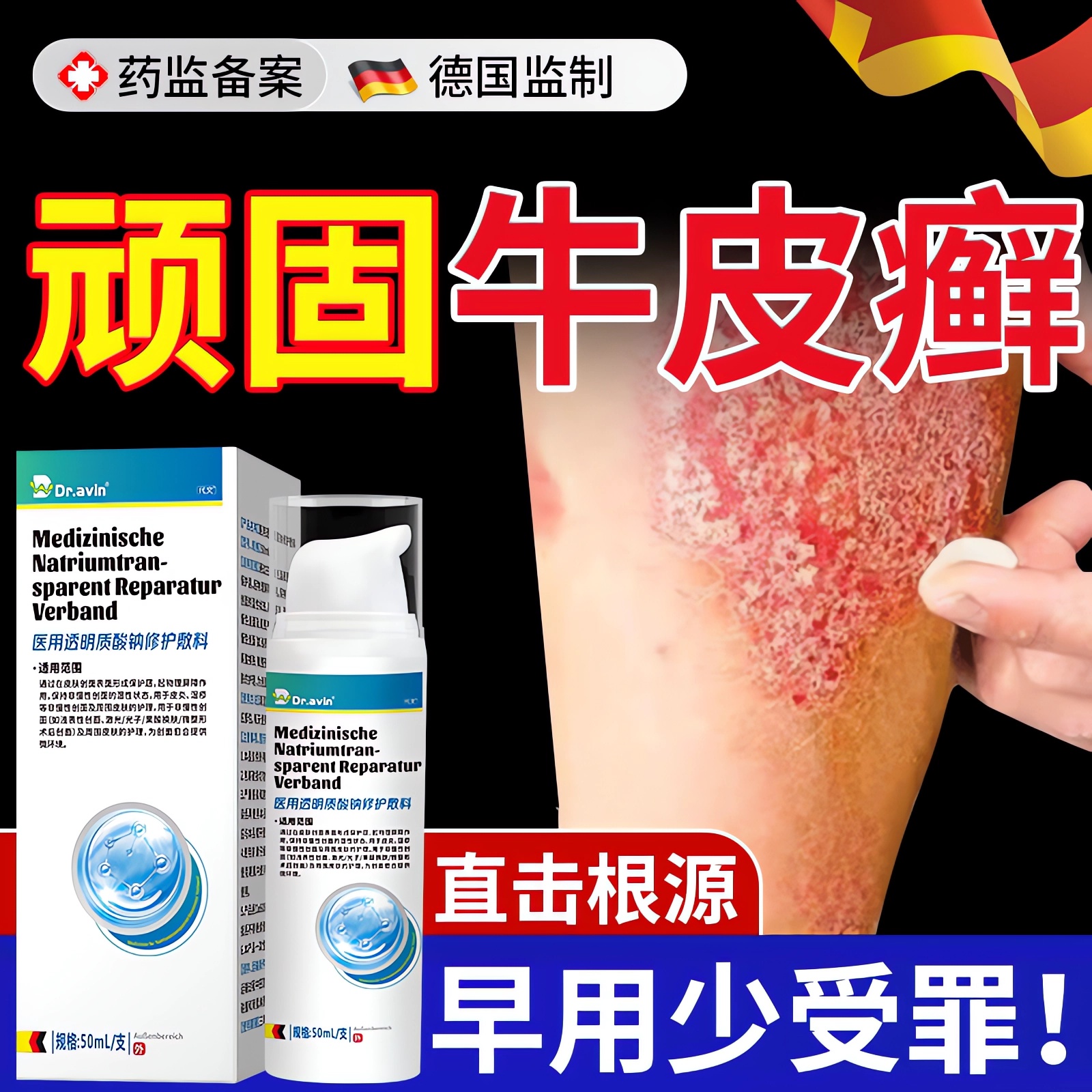 【德国代文】牛皮炫银屑病专用膏