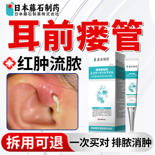 藤石制药耳前瘘管发炎消流脓肿痛防水贴外用清理工具药监备案JV