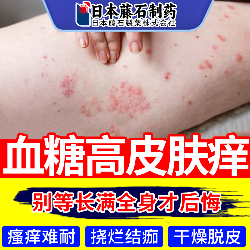 糖尿皮肤痒专用止痒膏老年人皮肤瘙痒高血糖全身皮肤干燥ZR