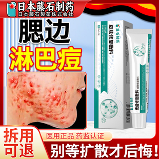 淋巴痘腮边痘结节硬块痘下巴痤疮反复长痘脖子脸颊两边下颚线痘ZR