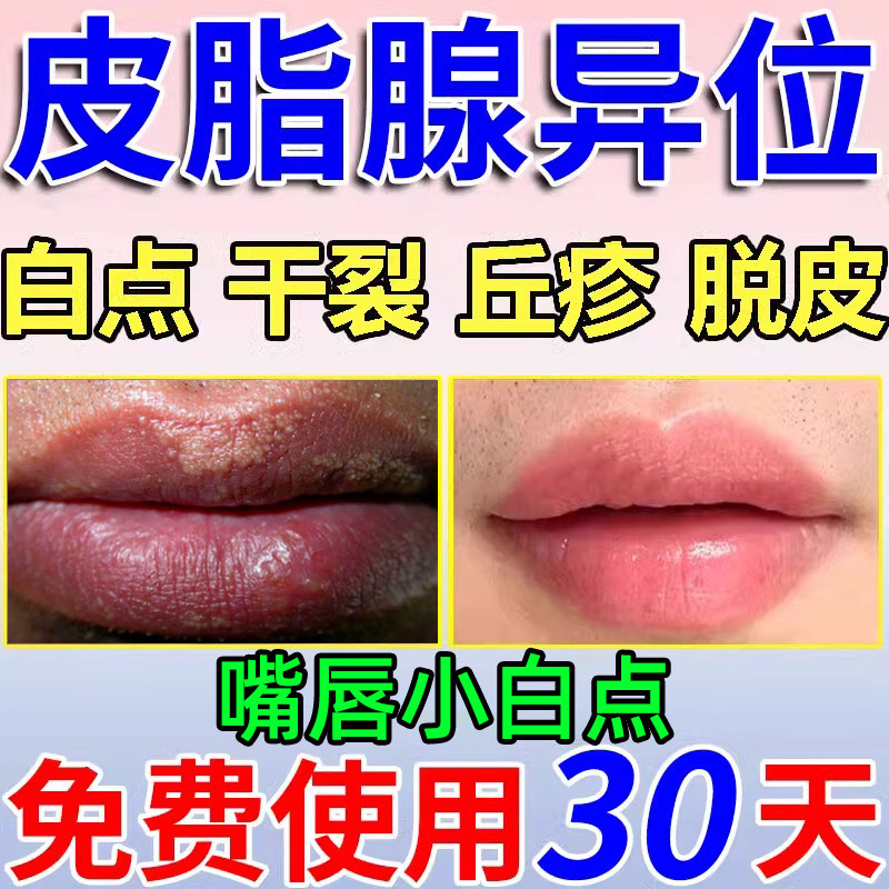 皮脂腺异位症嘴唇白点脂肪小颗粒嘴唇上有白点密集增生准用凝胶zr