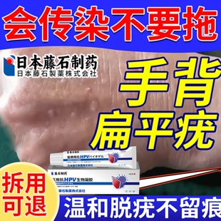 手背扁平疣专用去除膏一抹灵面颈部丝状疣瘊子疣体脱落药房同售ZR